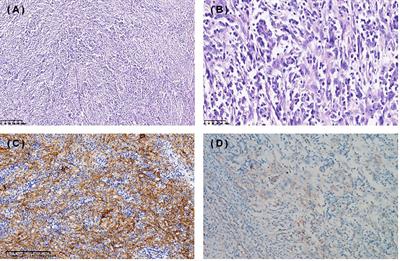 Favorable response to PD-1 inhibitor plus chemotherapy as first-line treatment for metastatic follicular dendritic cell sarcoma of the spleen: a case report